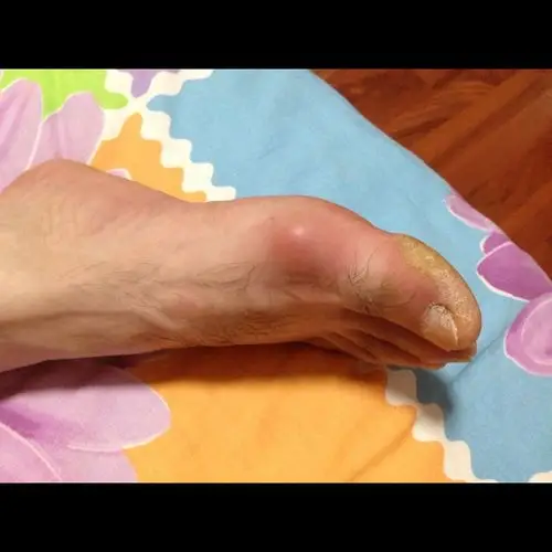 父亲右脚大拇指肿痛,不运动不疼穿鞋走路疼痛.什么原因.有痛风病史.