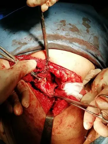 骶前巨大囊肿(病理确认:表皮样囊肿)