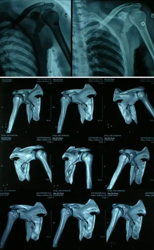 一例肩胛骨骨折的治疗. - 好大夫在线