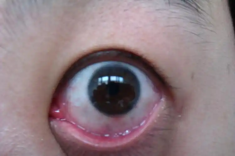 病毒性角膜结膜炎久治不愈,复发(恳求各位专家帮忙)