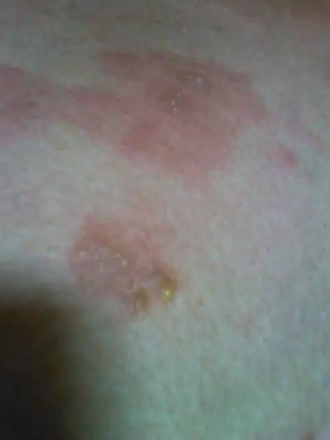 2013-10-12 余茂进 医师 手背被开水烫起水泡,现在已经到了恢复后期