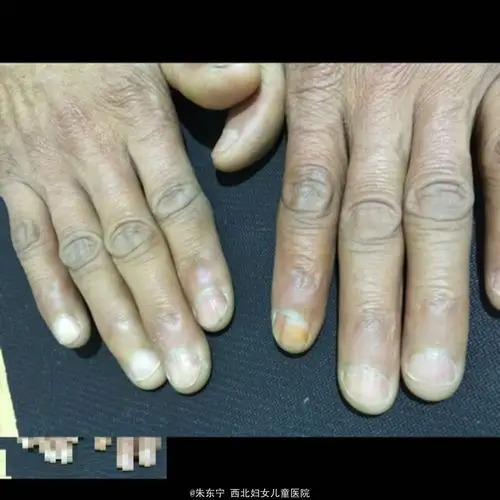 双手食指甲母痣一例