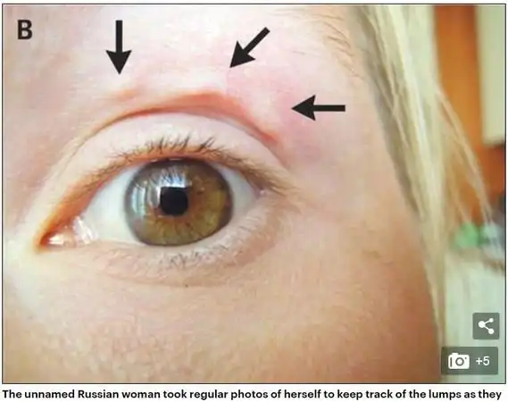 她脸上肿块不断「神秘移位」 真相令人毛骨悚然.