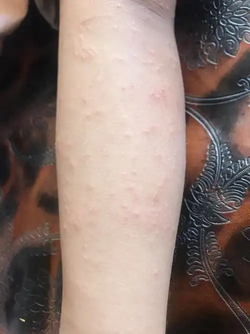 小孩胳膊起小白疙瘩咋回事?