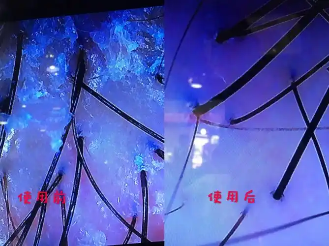 这是头皮放大200倍的情况下看到的头皮问题,姜医生洗护清洗后效果显著