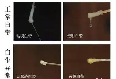阴道炎有很多种,怎么通过白带简单的去鉴别