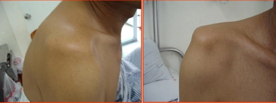 3,肩三角肌塌陷,呈方肩畸形,在腋窝,喙突下或锁骨下可触及移位的肱骨