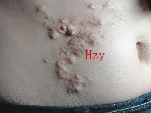 右腹部皮损15年,无自觉症状