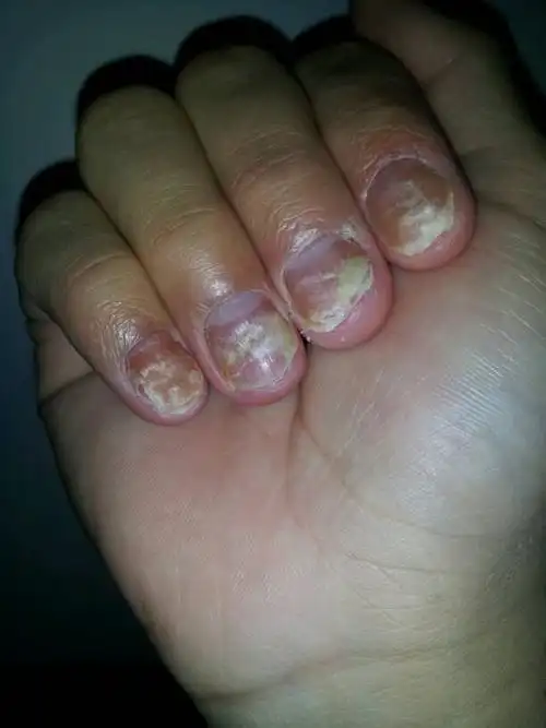 你好,你的症状描述情况是不排除真菌感染引起的甲癣的,也就是灰指甲