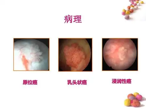 膀胱肿瘤病人的护理ppt