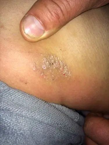 大腿内侧起了起了一片癣还是什么,有静脉曲张,那块痒,一痒就用手抓