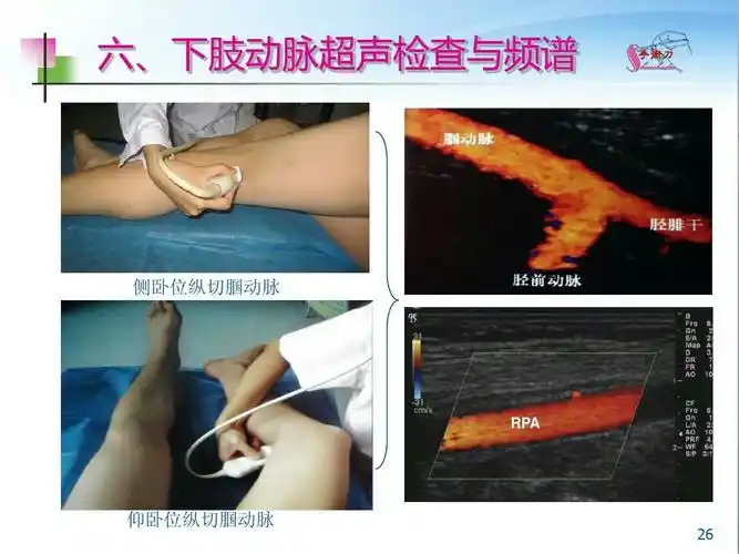 下肢血管超声检查