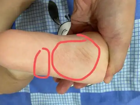 宝宝脚底有几块皮肤变色了,而且面积也变大了,去医院看过没有真菌感染