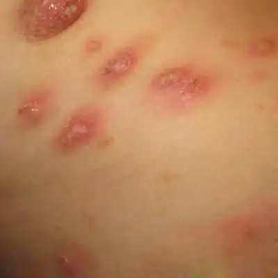 硬下疳初期图片(36)_有来医生