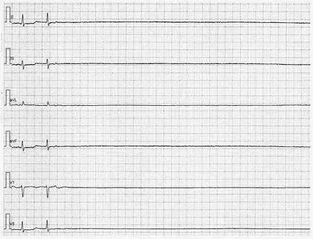 我前天在家做的24小时动态心电图,报告出来后显示我有几次心脏停搏2秒
