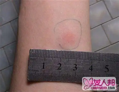 请问:肺结核皮试结果是强阳性,是什么意思啊?