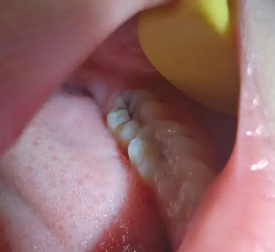 这牙齿看起来龋坏很小其实很严重了.