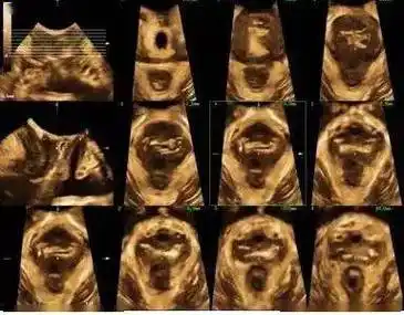 盆底超声检查图术前,刘颂平为了更加详细明确患者盆底的情况,评估手术