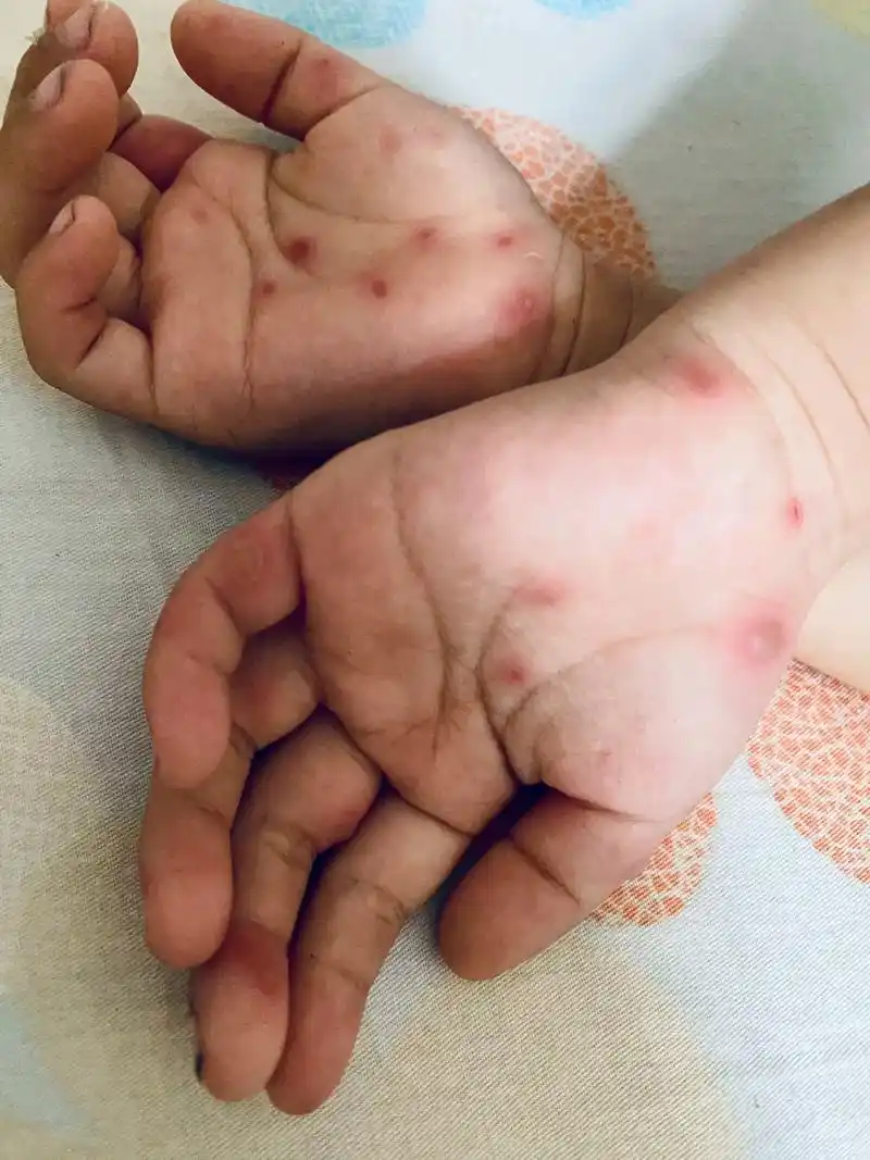 可怜的宝宝看着都心疼 #手足口病宝宝 今天第三天 低烧