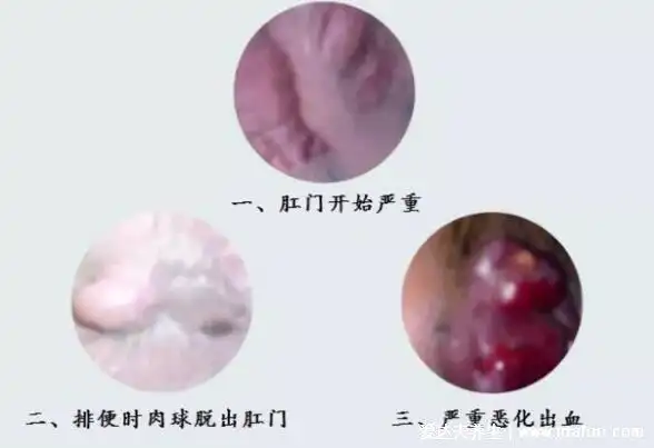 痔疮长什么样子的图片,含内痔/外痔/混合痔图片(混合痔要发病形式)
