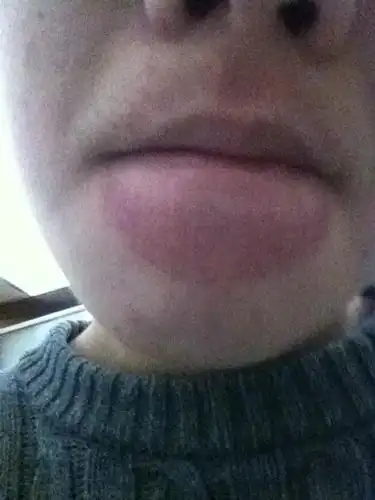 昨天嫌来没事用个杯子吸嘴巴变这样如何快速去掉