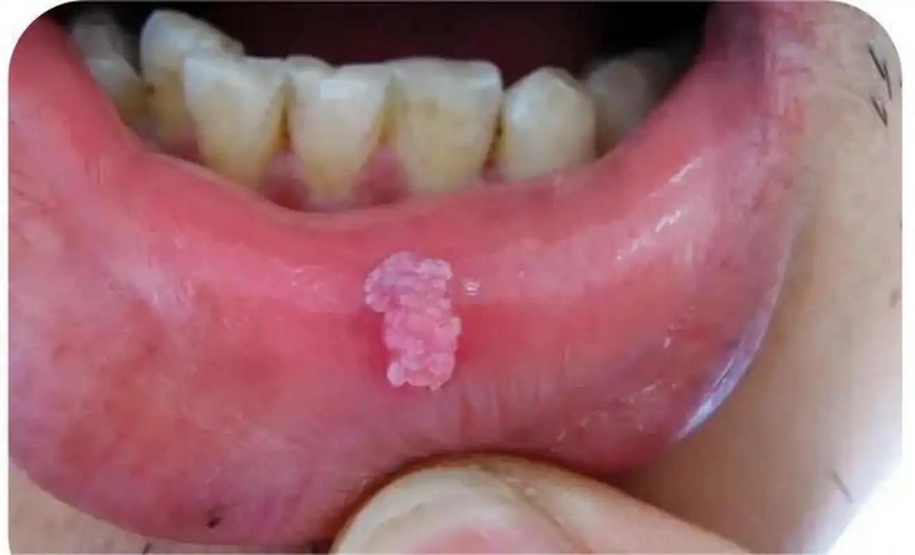 嘴巴长了菜花一样的肉球,这可能是hpv感染所导致的尖锐湿疣.