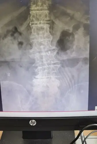 术前x线片,腰椎侧弯严重退变!