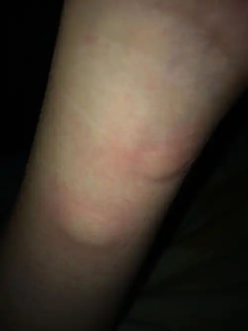 半夜醒来,突然就起了这个大包,不碰不痒,碰了就挺痒的,过一会越来越大