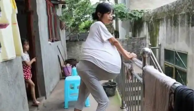孕妇肚子2年长成"巨球",家人以为怀上了多胞胎,医生:很危险_手机搜狐
