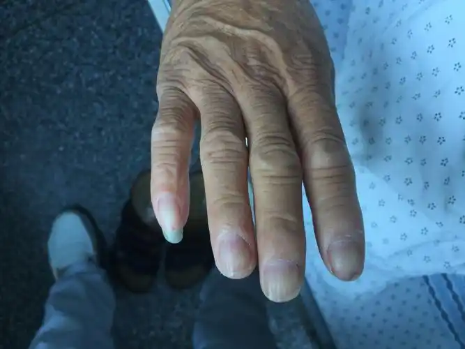 多名患者指甲过长