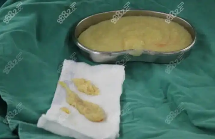 说我鼻部现在有很硬的疙瘩,而且已经发炎了,必须赶紧取出奥美定,随后