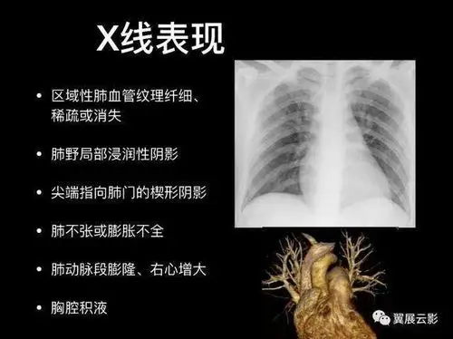 肺栓塞的临床表现 如何护理肺栓塞病人