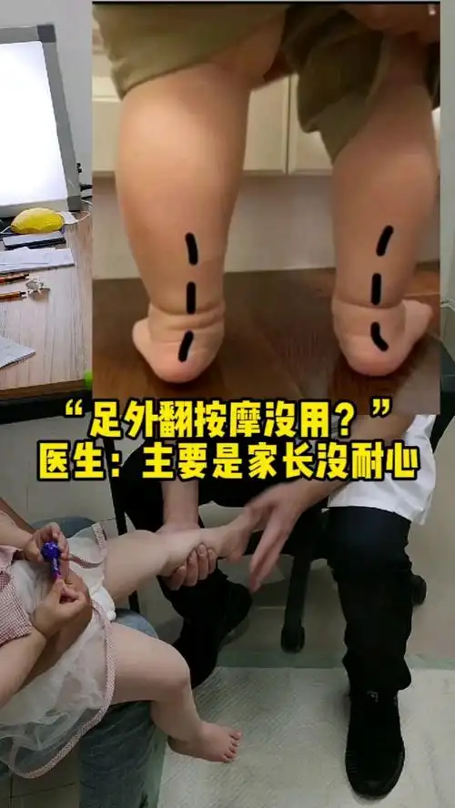 足外翻按摩没用医生主要是家长没耐心