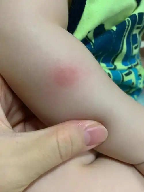 儿子摔断唇系带