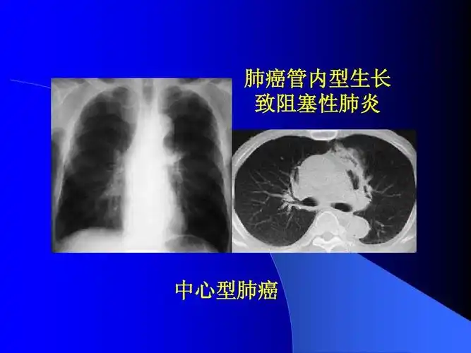 中心型肺癌