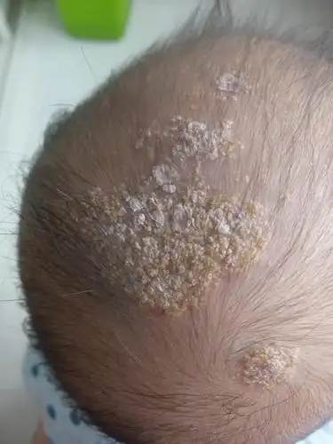 多注意,时间长了会出现问题,我家宝宝头上最后感染了,成了脂溢性皮炎