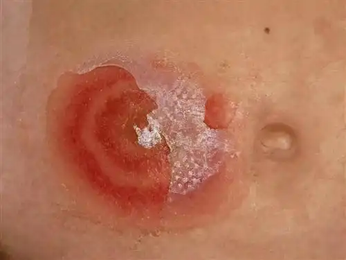 脓疱疮能吃什么水果