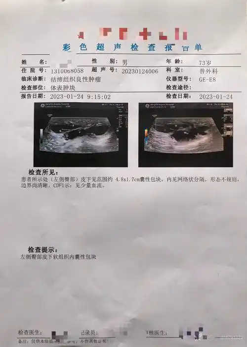 从里向外坐骨结节囊肿