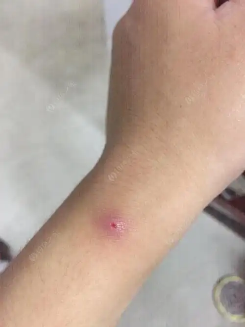 被红蚂蚁咬了四天了,伤口还没有愈合,有什么好方法吗?