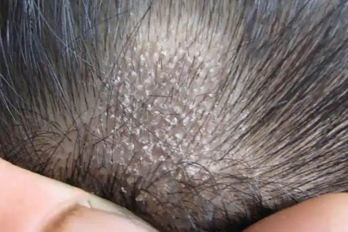 各种皮癣的图片大全