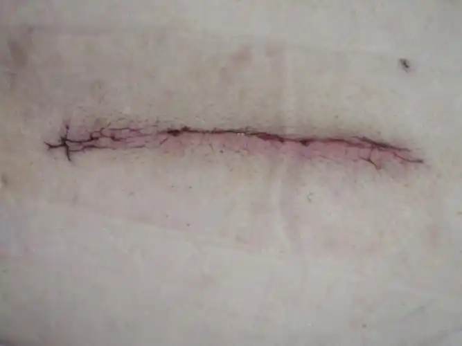 王济田胸12椎体chance骨折