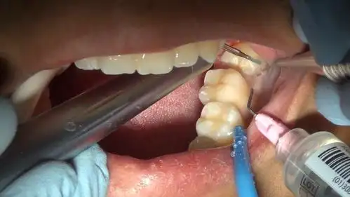 54 03:54 为您推荐: 医学双语科普:支气管镜 视频翻译by@再也不拔智齿