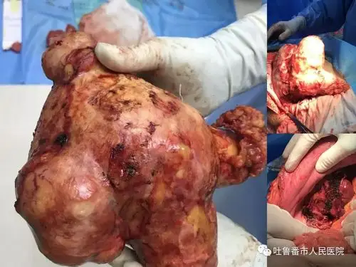 头条∣干的漂亮博士院长带领普外科团队完整取出巨大肝包虫