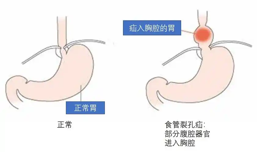 什么是食管裂孔疝反流烧心怎么治疗