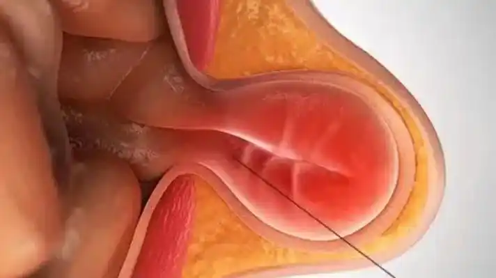 睾丸疝气图片 (32)_有来医生