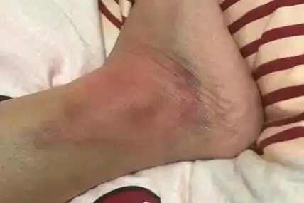 4,针刺和拔罐若是崴脚后已经出现了局部瘀肿,需要很长时间才能够消肿