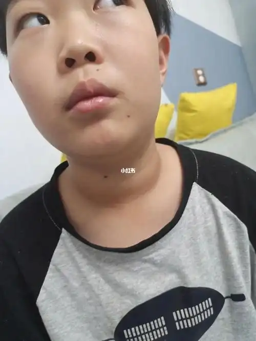 儿子脖子很粗会不会是甲状腺#甲状腺
