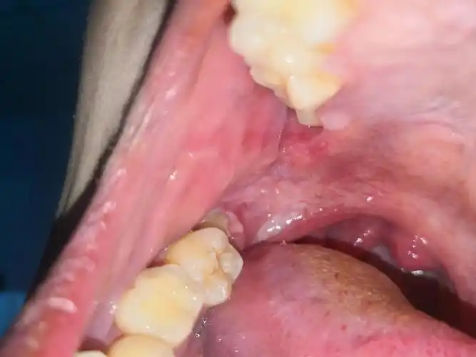 一生帮我看看我是长了牙息肉还是上火,下牙智齿位置长了个小芽芽,疼