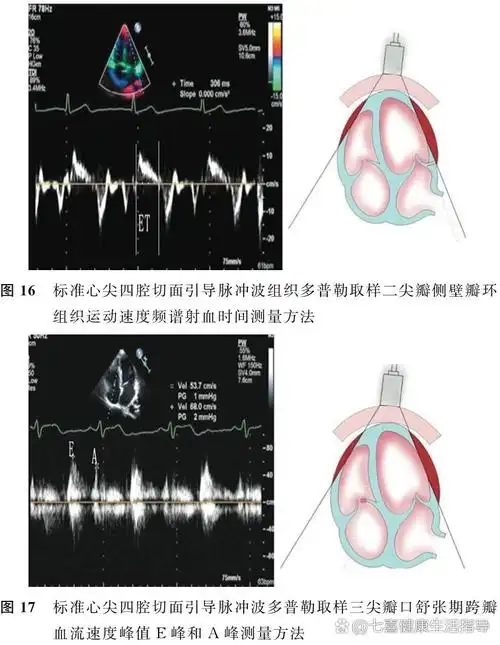 心脏超声标准切面 对应教材p59. 1.