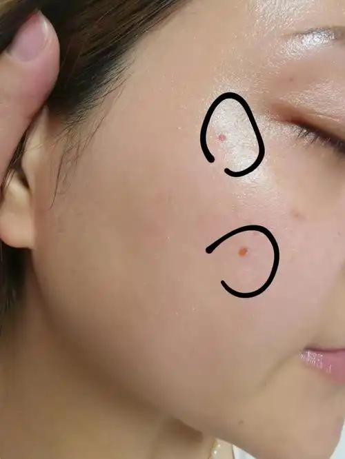 二氧化碳激光点痣第三天